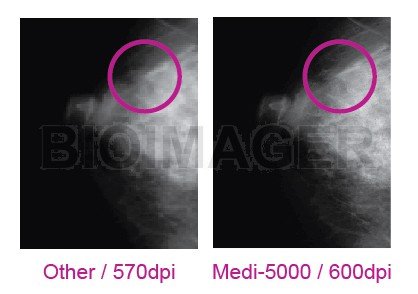 Medi 5000 Digitizer for Mammography Grade Certified by CE MDD & TFDA -10401