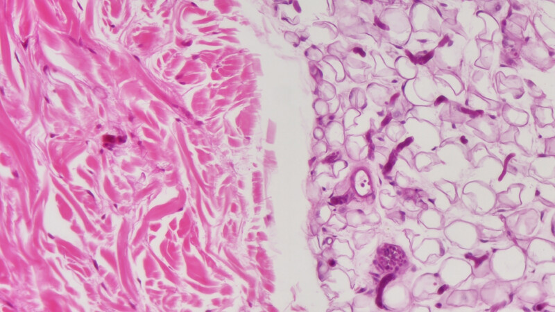 BIC-AF5-Medical-pathological-observation